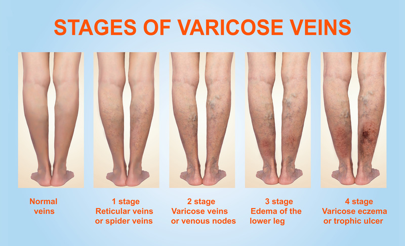 stages of varicose veins